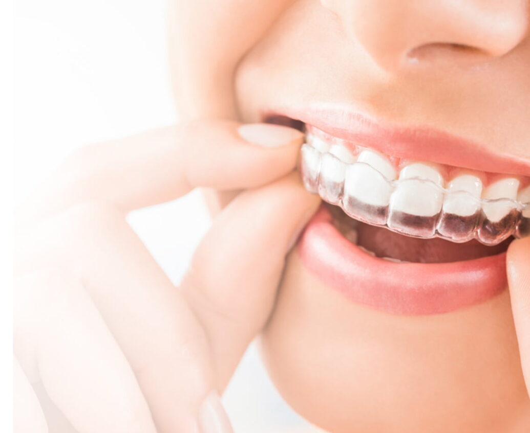 invisalign-thumb1 Invisalign Image