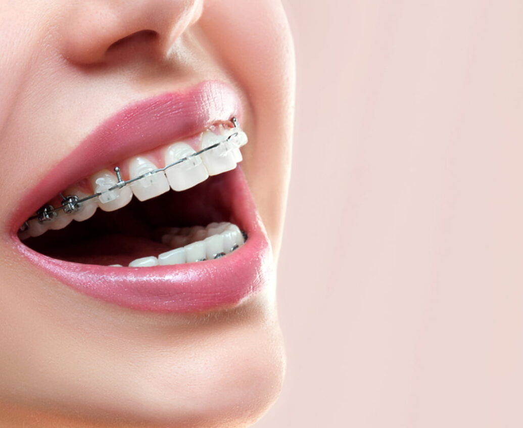 invisalign-thumb2 Invisalign Image