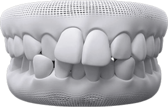 Crowded teeth invisalign before after