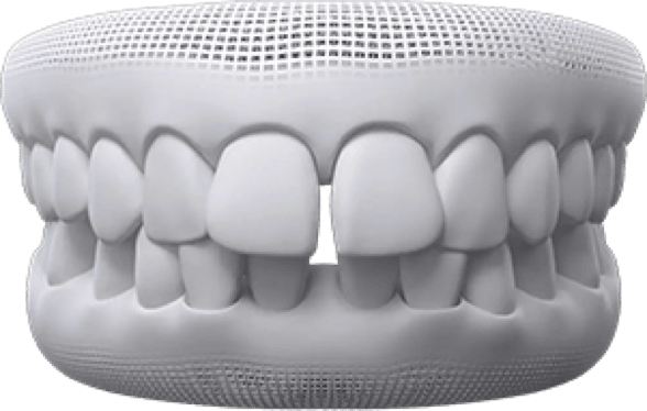 Overbite invisalign before after