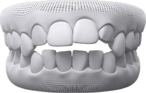 Overbite invisalign before after