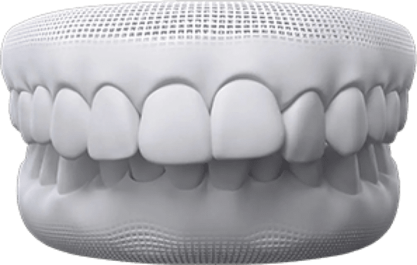 Open bite invisalign before after