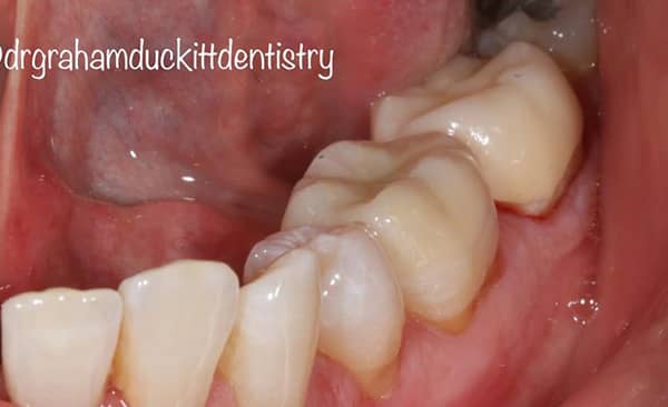 After - Taylored Dental Care